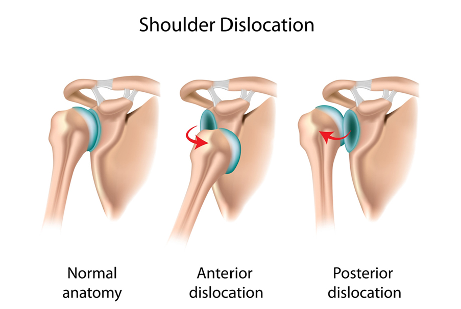 Shoulder Arthroscopy by Dr. Aditya Pawaskar, Specialist in Arthroscopy and Sports Injuries in Mumbai, Maharshtra in Matunga and Tardeo Road.