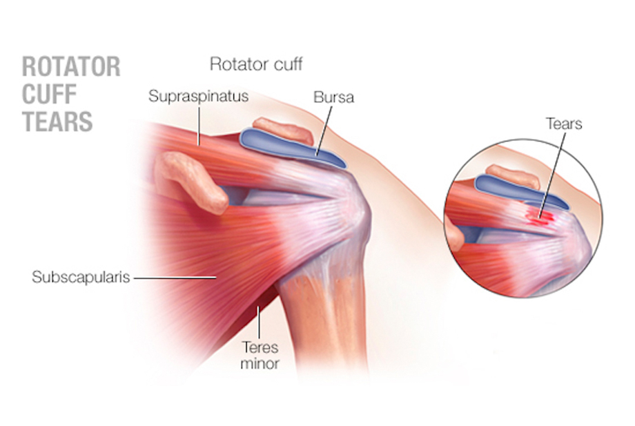 Shoulder Arthroscopy by Dr. Aditya Pawaskar, Specialist in Arthroscopy and Sports Injuries in Mumbai, Maharshtra in Matunga and Tardeo Road.