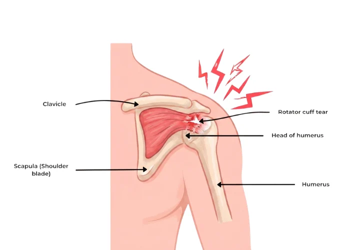 Understanding Rotator Cuff Tear and Shoulder Damage