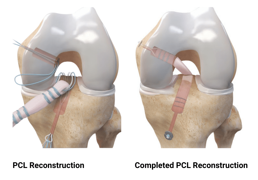 Posterior Cruciate Ligament Tear and Reconstruction  by Dr. Aditya Pawaskar, Specialist in Arthroscopy and Sports Injuries in Mumbai, Maharshtra in Matunga and Tardeo Road.