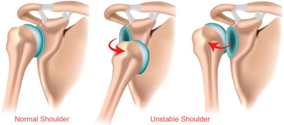 Shoulder Arthroscopy by Dr. Aditya Pawaskar, Specialist in Arthroscopy and Sports Injuries in Mumbai, Maharshtra in Matunga and Tardeo Road.