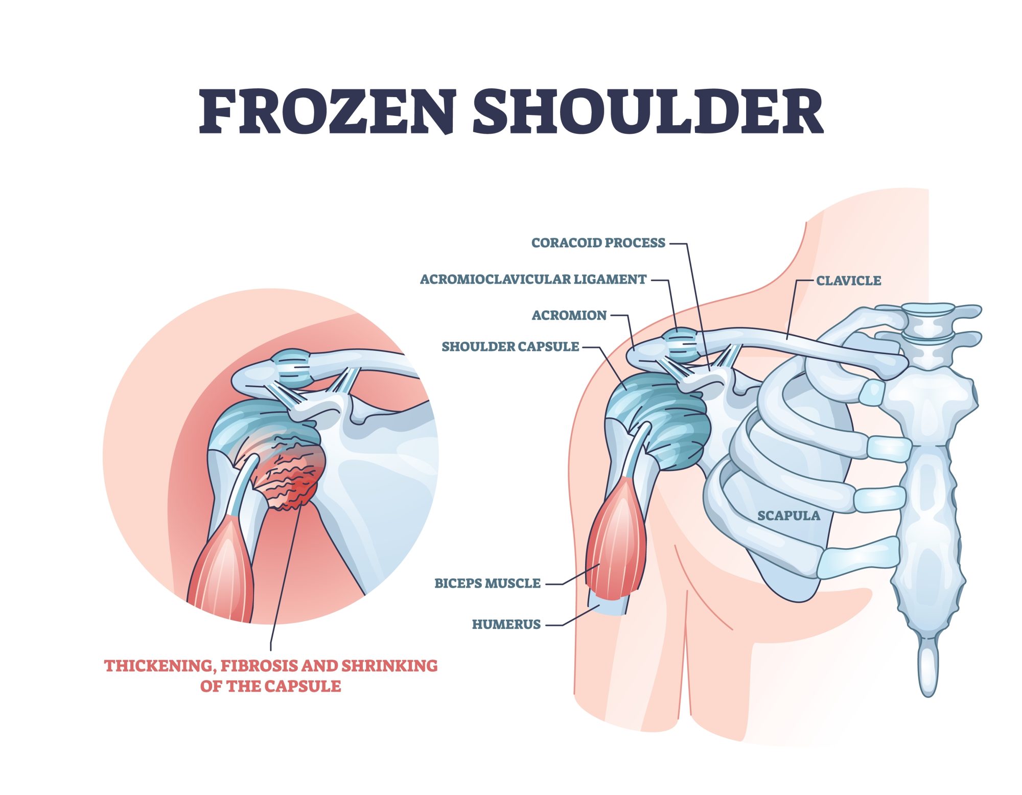 Frozen Shoulder Treatment by Dr. Aditya Pawaskar, Specialist in Arthroscopy and Sports Injuries in Mumbai, Maharshtra in Matunga and Tardeo Road.
