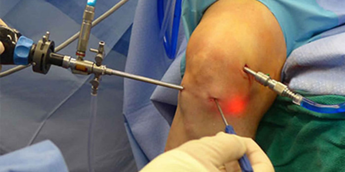 Knee arthroscopy by Dr. Aditya Pawaskar, Specialist in Arthroscopy and Sport Injury in Mumbai, Maharshtra in Matunga and Tardeo Road.