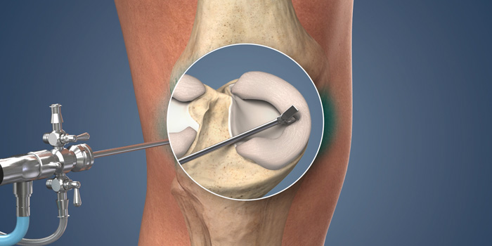 Meniscus Repair by Dr. Aditya Pawaskar, Specialist in Arthroscopy and Sport Injury in Mumbai, Maharshtra in Matunga and Tardeo Road.