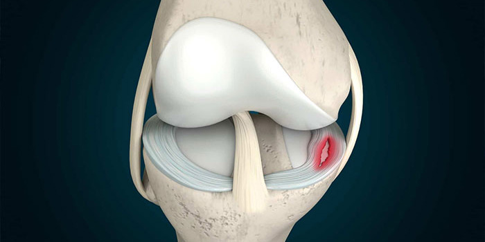 Meniscus Tear by Dr. Aditya Pawaskar, Specialist in Arthroscopy and Sports Injuries in Mumbai, Maharshtra in Matunga and Tardeo Road.