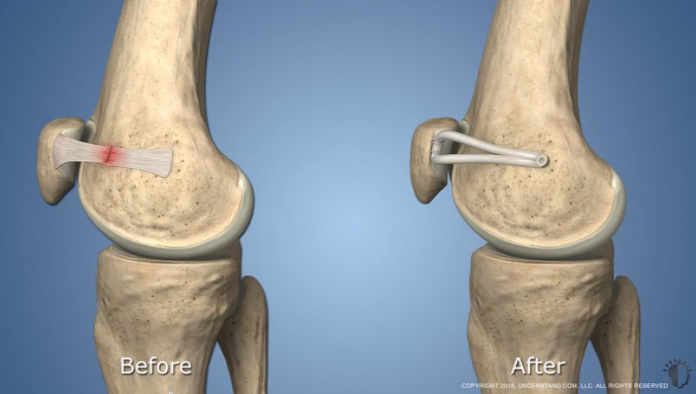 Patella Dislocation, MPFL Tear and Reconstruction by Dr. Aditya Pawaskar, Specialist in Arthroscopy and Sports Injuries in Mumbai, Maharshtra in Matunga and Tardeo Road.