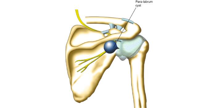 Paralabral Cyst Decompression by Dr. Aditya Pawaskar, Specialist in Arthroscopy and Sports Injuries in Mumbai, Maharshtra in Matunga and Tardeo Road.