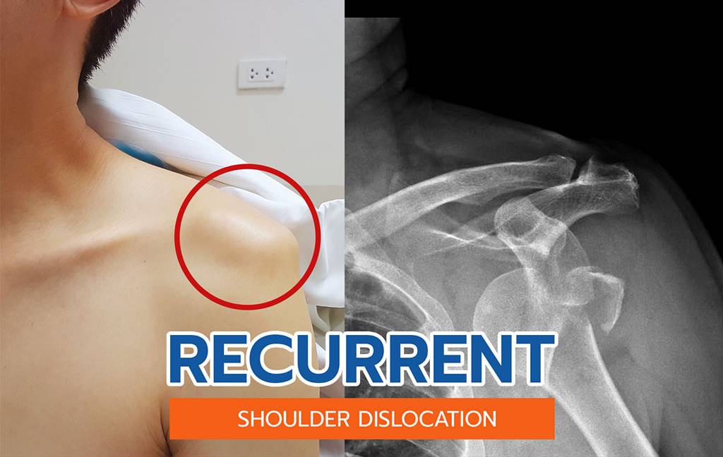 Recurrent Shoulder Dislocation Treatment by Dr. Aditya Pawaskar, Specialist in Arthroscopy and Sports Injuries in Mumbai, Maharshtra in Matunga and Tardeo Road.