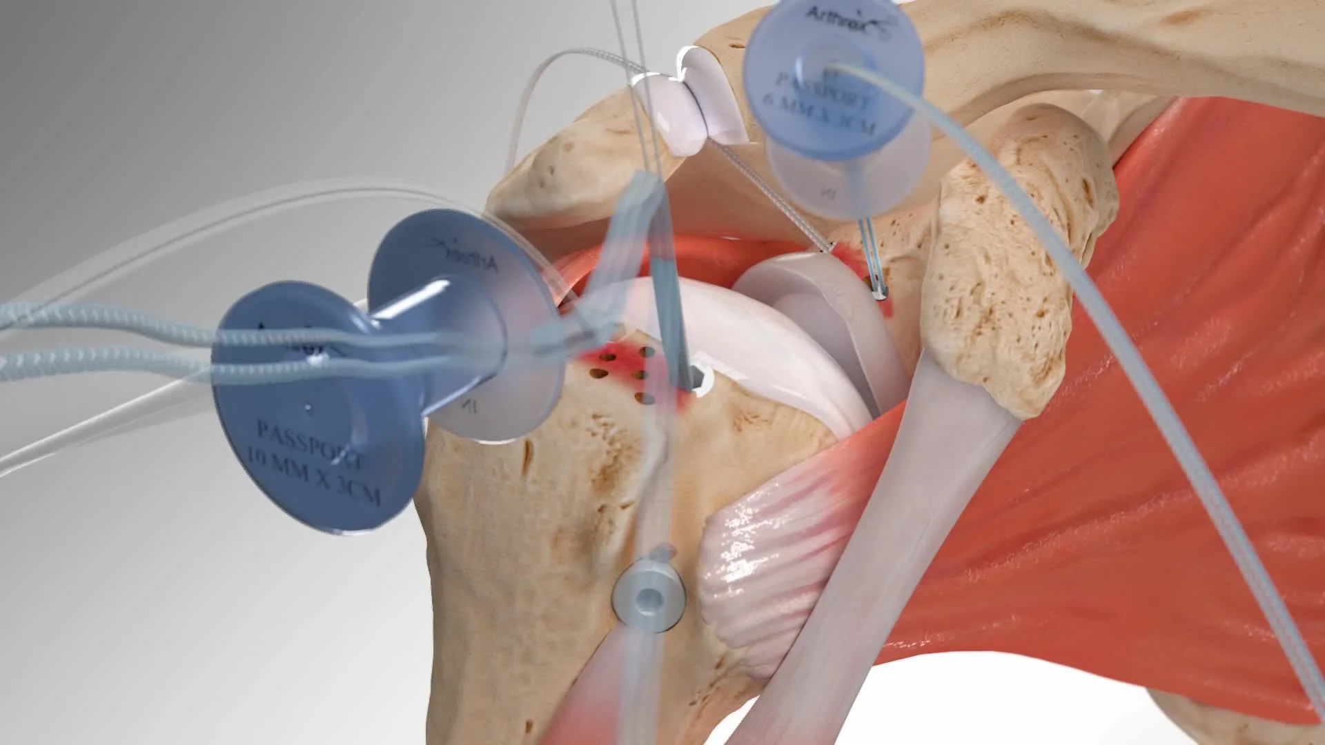 Superior Capsular Reconstruction for Large Rotator Cuff Tears by Dr. Aditya Pawaskar, Specialist in Arthroscopy and Sports Injuries in Mumbai, Maharshtra in Matunga and Tardeo Road. 