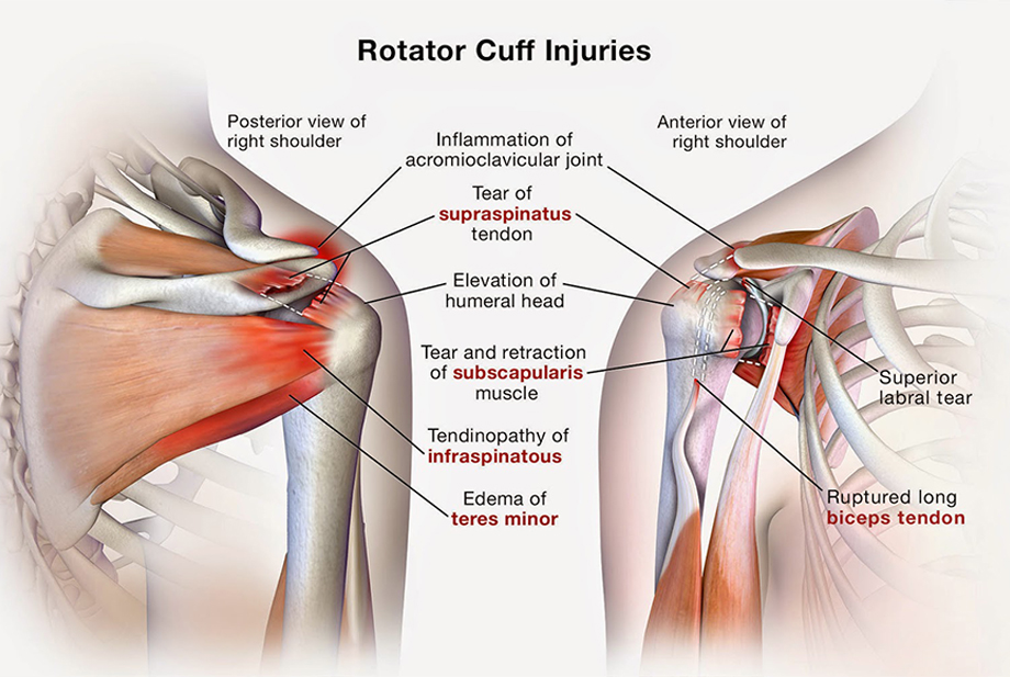 Shoulder Arthroscopy by Dr. Aditya Pawaskar, Specialist in Arthroscopy and Sports Injuries in Mumbai, Maharshtra in Matunga and Tardeo Road.